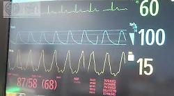 Scotte, le parole del professore Marco Mandal&agrave; dopo l'innovativo intervento con chirurgia robotica - IL VIDEO