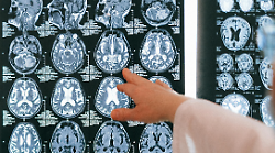 Tumore al cervello, altre quattro diagnosi tra i vigili del fuoco, tre morti. Cos'è il glioblastoma, le terapie, il tasso di sopravvivenza. L'ultimo farmaco scoperto