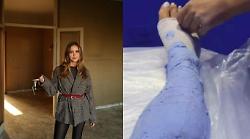 Valentina Ferragni si fa ingessare le gambe. Cos'è la "calcoterapia" estetica e a cosa serve