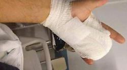 Botti di capodanno, la notte di follia di Andrea Buzzi: la mano distrutta, l'occhio colpito da un razzo, le dimissioni ribelli dall'ospedale. Chi &egrave; il 24enne