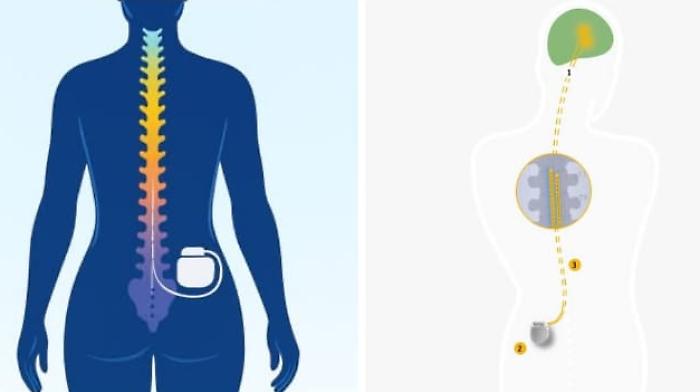 Impiantati a Perugia i primi "pacemaker" per combattere il dolore 